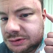 Тимати показал разбитую челюсть диджея Smash и обозвал депутата «гнилым пидарастом»