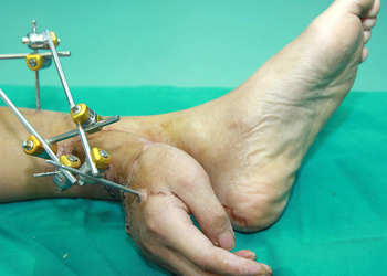 Китайские хирурги пришили оторванную руку к ноге